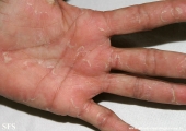 keratolysis_exfoliativa