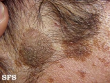 keratosis seborrheic
