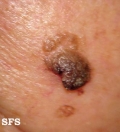 keratosis seborrheic