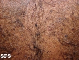 keratosis seborrheic