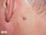 keratosis seborrheic