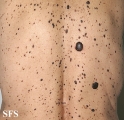 keratosis seborrheic