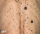 keratosis seborrheic