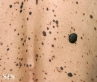 keratosis seborrheic