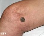 keratosis seborrheic