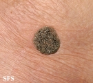 keratosis seborrheic