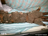 keratosis seborrheic