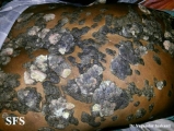 keratosis seborrheic