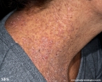 darier's disease