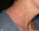 darier's disease