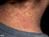 darier's disease