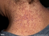 darier's disease