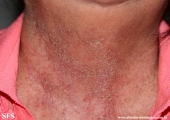 darier's disease