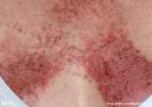 darier's disease