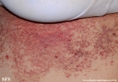 darier's disease