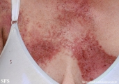 darier's disease