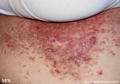 darier's disease