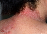 darier's disease