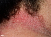 darier's disease