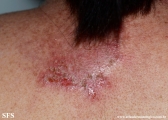 darier's disease