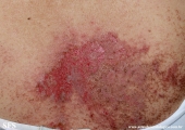 darier's disease