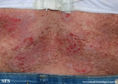 darier's disease