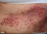 darier's disease