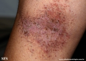darier's disease