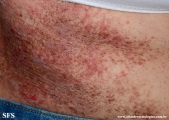 darier's disease