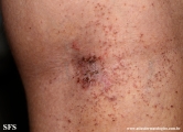 darier's disease