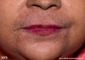 darier's disease