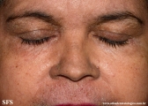 darier's disease