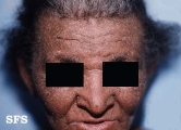 darier's disease