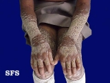 darier's disease