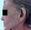 darier's disease