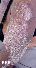 darier's disease