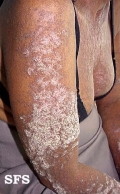 darier's disease