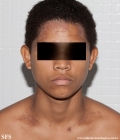 darier's disease