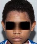 darier's disease