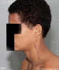 darier's disease