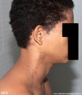 darier's disease