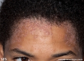 darier's disease