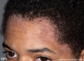 darier's disease