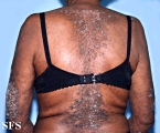 darier's disease