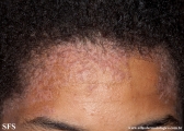 darier's disease