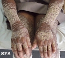 darier's disease
