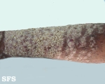 darier's disease