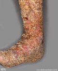 darier's disease