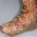 darier's disease