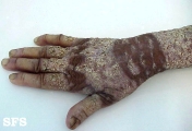 darier's disease